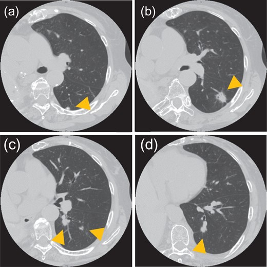 CT shows five nodules in the left lower lobe. Tumor sizes and locations: (a) 0.8 cm in S6a, (b) 2.1 cm in S6a, (c) 1.3 cm and 0.8 cm in S6c and (d) 1.1 cm in S10a. All nodules were located in S6 or S10a.