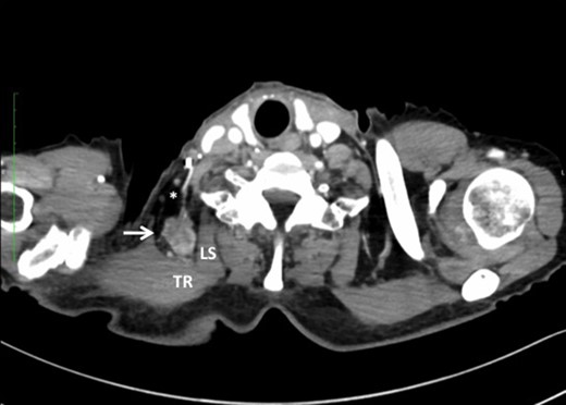 Note that the transverse cervical vessels (*) were involved in the tumor (arrow). TR, trapezius muscle; LS, levator scapulae muscle.