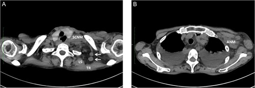 Metastasis of the supraclavicular nodes (SCNM), the nodes located between TR and LS (arrow) (A), and the axillary nodes (ANM) (B) developed 4 months after esophagectomy.