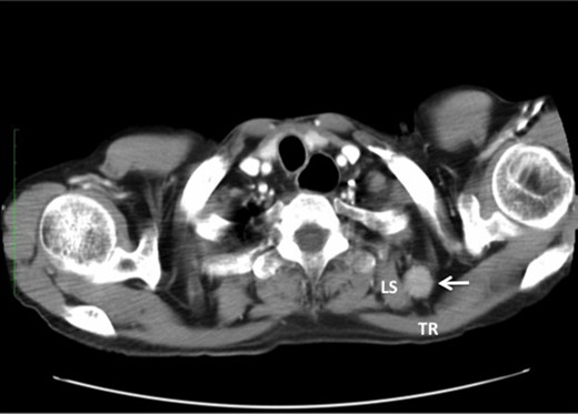 Undifferentiated carcinoma was confirmed by excisional biopsy of the tumor located between TR and LS (arrow).