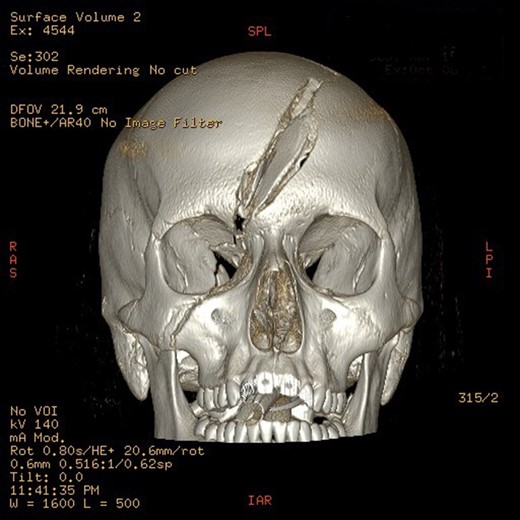 3D reconstruction of fractured skull.