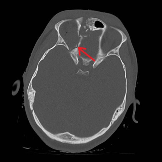 Right medial orbital wall fracture showing route of CSF leak.