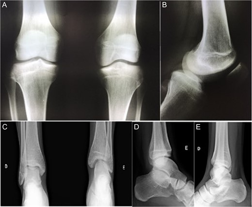 AP radiographic view of the knees (A) and lateral view of left knee—affected (B). AP (C) and lateral view (D and E) of the ankles. Note in (A) tibial spines hypoplasia of left knee, and in (C) left tibiotarsic joint dysplasia with fibular shortening, also noted in (D).