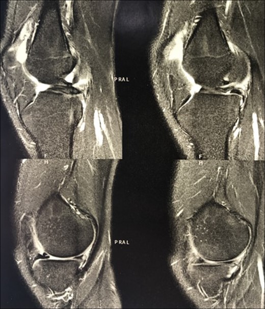 MRI of the affected knee showing the congenital absence of the cruciate ligaments (circles) and the presence of a bucket handle tear of the medial meniscus (arrow).