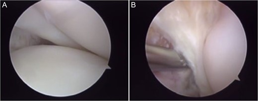 Arthroscopy surgery view during cruciate ligaments reconstruction. Note in (A) and (B) the ligaments absence. The lateral meniscus has not its bone tibial insertion of the posterior horn (*), which continued with the anterior meniscus femoral ligament (Humphry), which was hypertrophied (**). LFC, lateral femoral condyle.