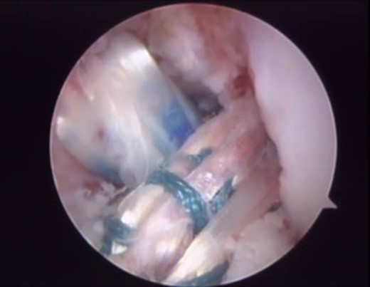 Final arthroscopic surgery image of the ACL and PCL reconstruction with the grafts tense and well positioned.