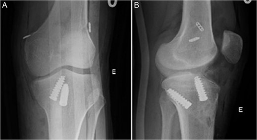 Radiographic image in AP (A) and lateral view (B) of left knee after surgery.
