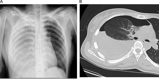 Initial chest X-ray (A) and computed tomography (B) revealed right pneumothorax with 30% lung collapse and niveau level.