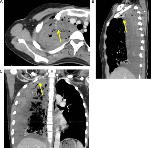 Axial (A), sagittal (B) and coronal (C) view of contrast-enhanced computed tomography revealed extra-vascular signs (arrows) on top of the right pleural cavity.