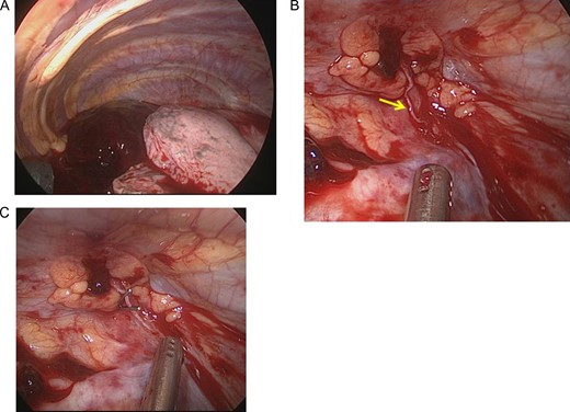 The operative findings showed a large amount of coagulation in the thoracic cavity (A). After evacuation of the coagulation, continuous bleeding from a small aberrant vessel at the top of the thoracic cavity was observed (arrow) (B). The aberrant vessel was clipped (C).