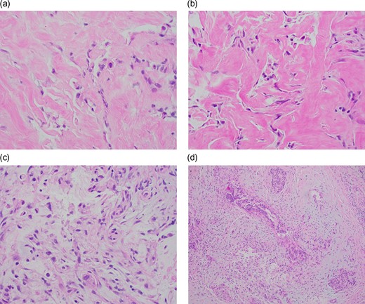 (a) Signet ring cells present singly and in loose clusters within a desmoplastic and fibrotic stroma (H&E, ×400). (b) Signet ring cells seen in an extensive background of fibrosis (H&E, ×400). (c) Signet ring cells with vacuolated to clear cytoplasm noted in a desmoplastic stroma with some associated background mucin (H&E, ×400). (d) Chronic pancreatitis-like areas seen adjacent and admixed with the tumor cells (H&E, ×100).