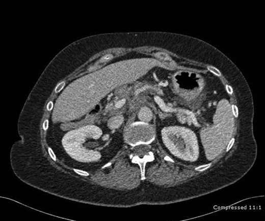 CT abdomen depicting a diffuse tissue mass in the head and tail of the pancreas.