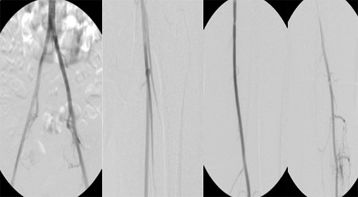 Fluoroscopy showing; left external iliac artery (EIA), common femoral artery (CFA), superficial femoral artery (SFA), patent previously placed stent, patent above and below the knee popliteal artery (PA) and two vessel run off to the foot.