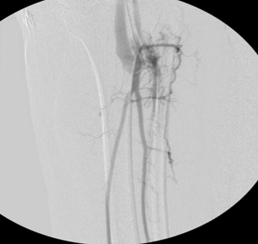 Fluoroscopy imaging showing high volume anterior tibial artery to vein iatrogenic fistula.