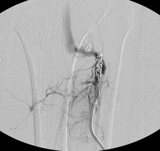 VortX coils (Boston Scientific) were placed from the curve of anterior tibial artery to its communication with venous system.