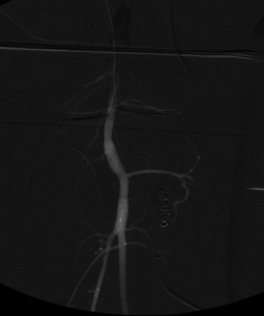 Anterograde angiogram showed no flow through the fistula tract with two vessels run off.