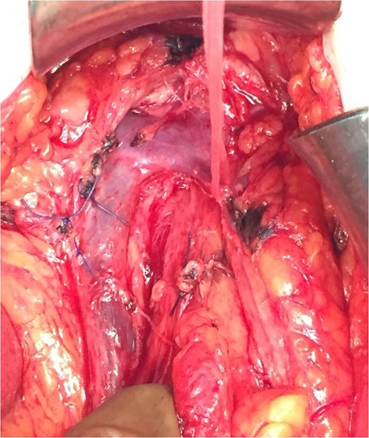 It is depicted the principal finding of our case, the anatomic variation of the middle colic vein draining to splenic vein.