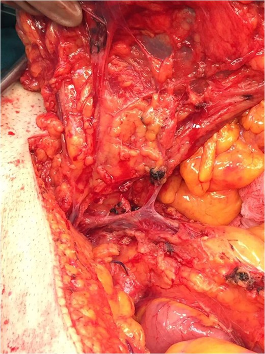 The venous anatomy of the right colon in our case.
