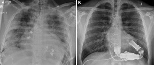 Chest radiographs (A) on admission, and (B) following implantation of a HeartMate II Left Ventricular Assist Device.