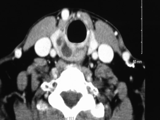 Contrast enhanced computed tomography of the neck showing a bi-lobed cystic mass (2.0 × 1.3 cm2) medial to the inferior right lobe of right thyroid associated with the cricoid cartilage causing displacement of the oesophagus.