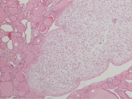 Pathological specimen showing high-grade chondrosarcoma invading into surrounding right lobe of thyroid gland using hematoxylin and eosin stain under ×10 magnification.