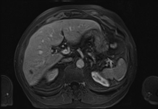MRI Scan showing hepatic epithelioid hemangioendothelioma (HEHE).