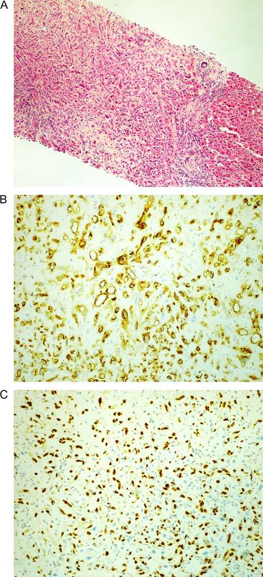 Histology images. (A) Hepatic epithelioid hemangioendothelioma (HEHE). (B) CD31 +ve and (C) ERG +ve.