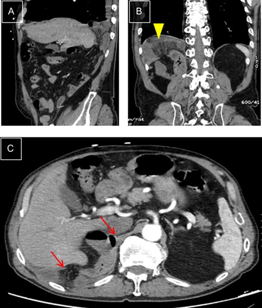 Right diaphragmatic hernia. (A) Thoracic-abdominal CT angiography, sagittal cut, showing right posterior location. (B) Coronal cut: Ileal loop in supradiaphragmatic position (arrowhead). (C) Transverse cut: edges of hernial ring (arrows).