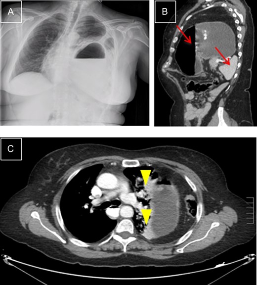 Left diaphragmatic hernia. (A) Chest X-ray with visceral herniation in the chest and mediastinal shift. (B) CT, sagittal view with dilated stomach and spleen in left side of chest (arrows). (C) CT, transverse view: compressed lung parenchyma with atelectasis due to gastric compression (arrowheads).