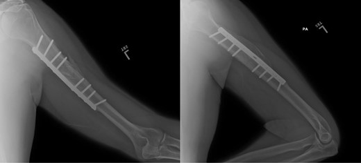 Plain films, AP/lateral showing appropriate alignment of fracture.