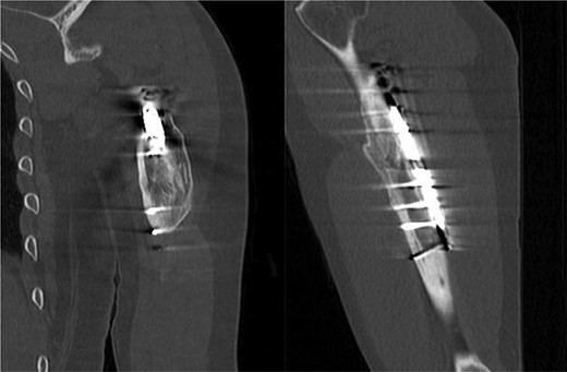 CT, coronal/sagittal showing a healed mid-shaft humerus fracture.