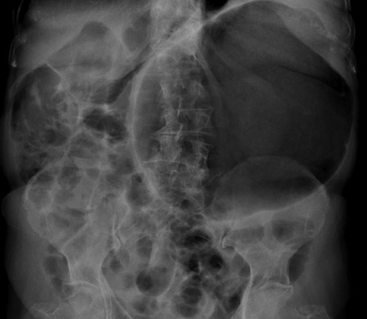 Abdominal radiograph, demonstrating a spherical stomach, presupposing an upward position of the pylorus.
