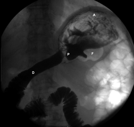 Upper gastrointestinal series, revealing an inverted stomach, with the atrum being positioned superiorly to the fundus and a stretched duodenal arch, with an abnormal position of the pylorus.