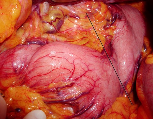 Findings during exploratory laparotomy, showing great laxity of the peritoneal ligaments and a bulky stomach.
