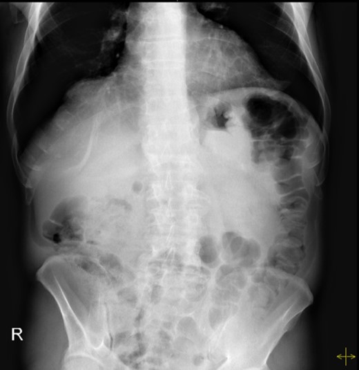 Abdominal radiograph performed during a symptomatic interval, showing no relevant changes.
