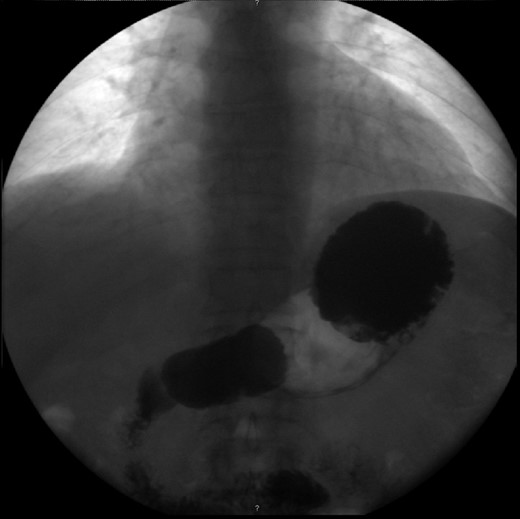 Upper gastrointestinal series, revealing an organoaxial torsion of the stomach.