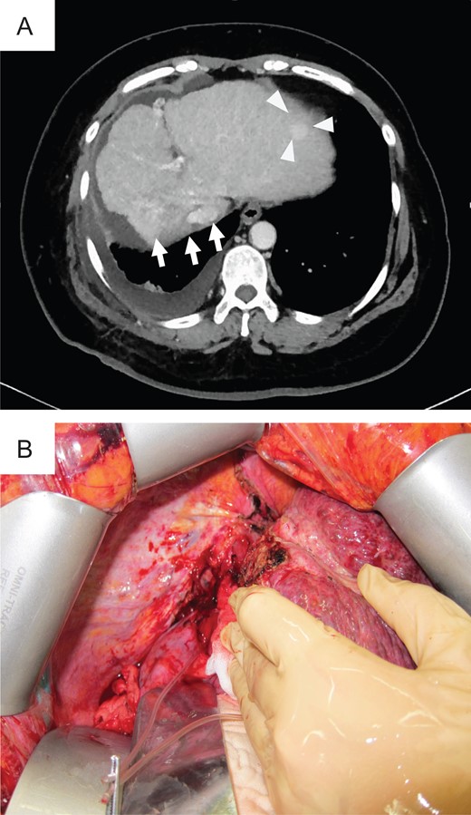Preoperative photograph and intraoperative images of case 1. (A) Liver atrophy was noted in the CIRT area (arrow), and a new lesion (triangle) was noted in the left lobe on preoperative CT. (B) Intraoperative imaging showed strong adhesion between the thoracic diaphragm and the CIRT area.