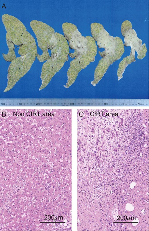The liver specimen of case 1. (A) The irradiated area showed an off-white color in the liver (dotted line area). H&E staining revealed normal liver in the non-CIRT area (B) and fibrotic liver in the CIRT area (C).