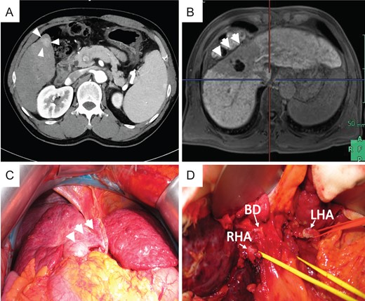 Preoperative photograph and intraoperative images of case 2. (A) New lesion in S6 on preoperative CT. Atrophy was noted in the CIRT area, and hypertrophy was noted in the left liver on preoperative EOB-MRI (B) and intraoperative images (C). (D) Severe tissue adhesion on the hepatic hilar resulted in difficulties during adhesiolysis.