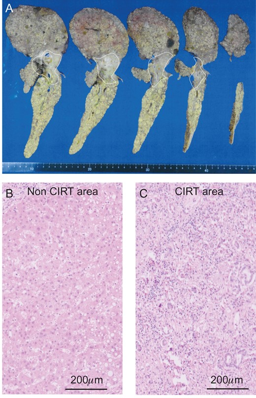 The liver specimen of case 2. (A) The irradiated area showed an off-white color in the liver (dotted line area). H&E staining revealed normal liver in the non-CIRT area (B) and fibrotic liver in the CIRT area (C).