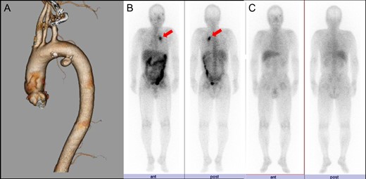 (A) CTA demonstrates DAA on the lesser curvature of the aortic arch. (B) Gallium 67 scintigraphy on first admission demonstrates uptake into the DAA (arrows). (C) Preoperative gallium 67 scintigraphy shows no uptake into the DAA.