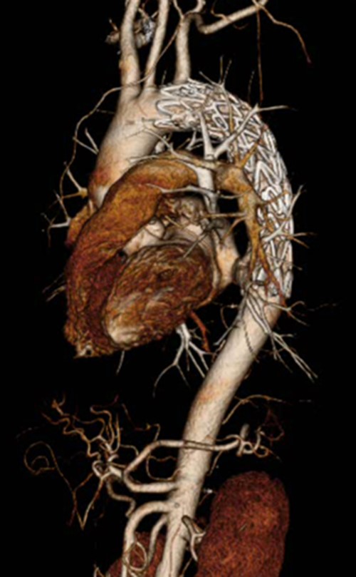 Postoperative CTA shows complete closure of the DAA.