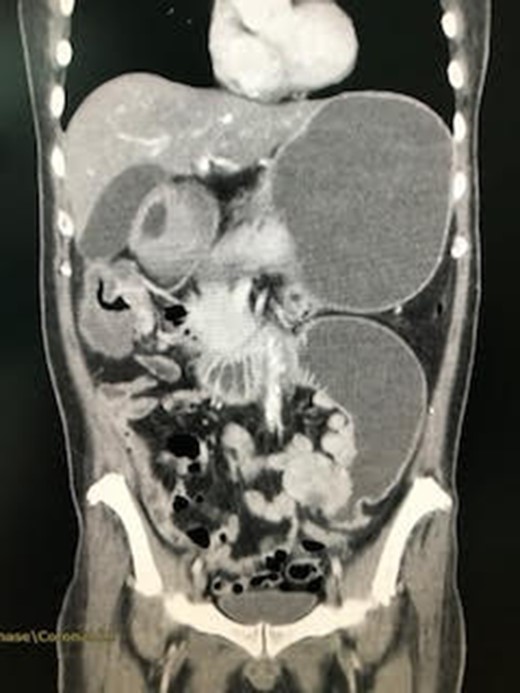 CT abdomen showed jejunal mass and proximal stomach and small intestine dilatation.