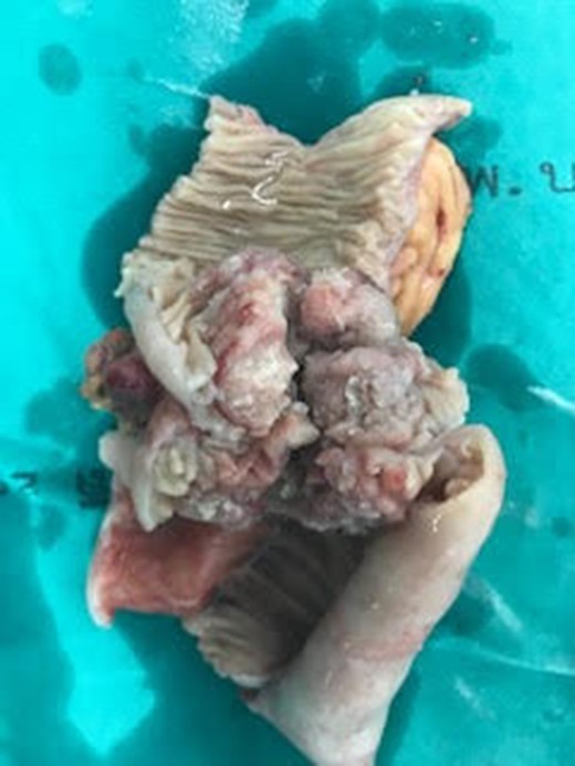 Gross specimen of resected jejunal mass.