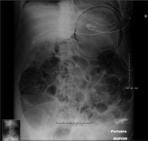 Portable abdominal x-ray significant for pneumatosis of the stomach, small bowel and colon, without evidence of pneumoperitoneum. Note that safety pins visible in the image are external objects.