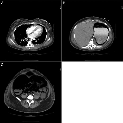 CT showing extensive pneumatosis involving the esophagus (A), the stomach (B) and the small bowel and colon (C). Hepatic portal venous gas is notable in (B).