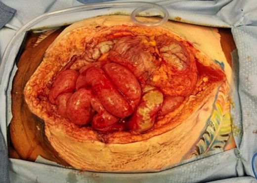 At the time of re-exploration, the colon from the ileocecal valve to rectosigmoid junction was frankly necrotic in addition to a 10 cm segment of small bowel near the prior resection. Orientation: left side of image is caudal, right side of image is cranial.