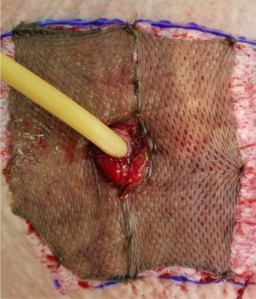 The end-ileostomy site was covered with human cadaver allograft prior to maturing the ileostomy in the standard fashion. A malecot drain is seen in the image.