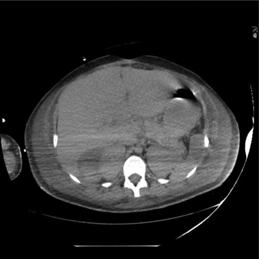 CT scan obtained on post-burn Day 19 demonstrating resolution of pneumatosis and hepatic portal venous gas.