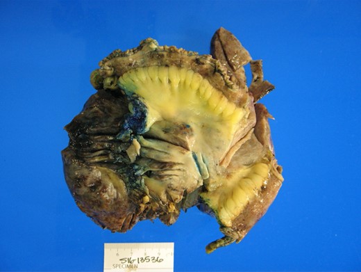 Gross image of mesenteric fibromatosis measuring >15 cm.